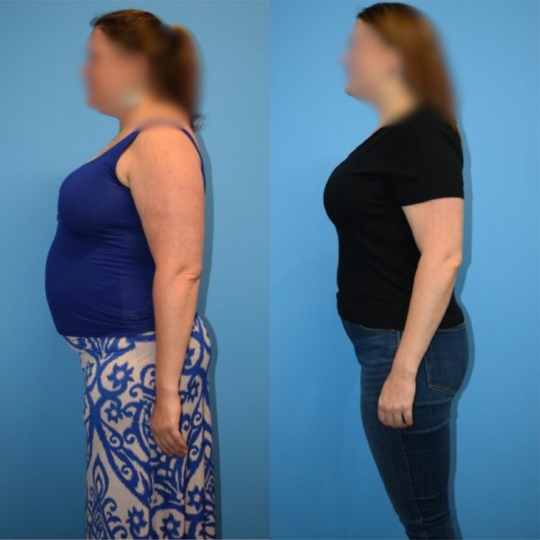 Before After 2